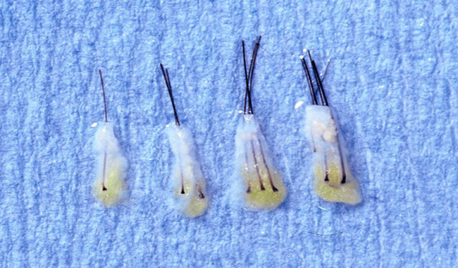 Transplante capilar